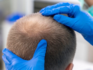 Hair PRP Treatment: How It Can Help with Hair Loss and Regrowth