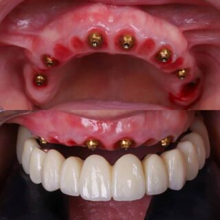 Soluciones avanzadas para la pérdida de dientes con implantes dentales innovadores