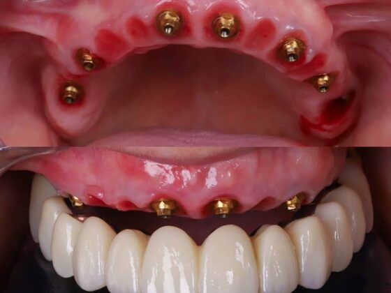 Soluciones avanzadas para la pérdida de dientes con implantes dentales innovadores